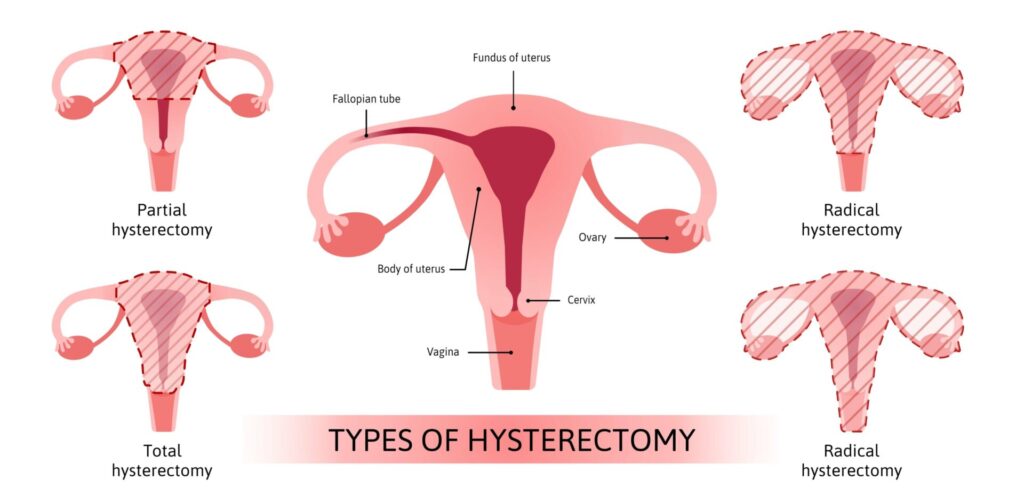 Types of Hysterectomy